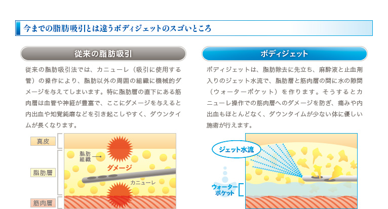 今までの脂肪吸引とは違うボディジェットのスゴいところ