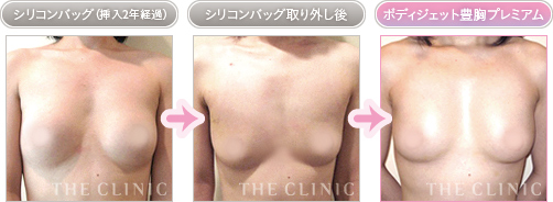 豊胸手術 症例写真