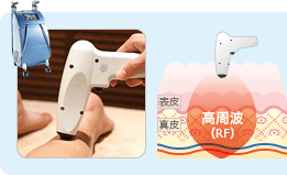 サーマルシェイプ 写真