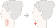 取り過ぎると、術後に皮膚のたるみだけが残ることがあるので注意が必要です