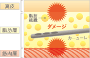 従来の脂肪吸引施術の施術