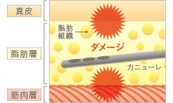 従来の脂肪吸引の方法